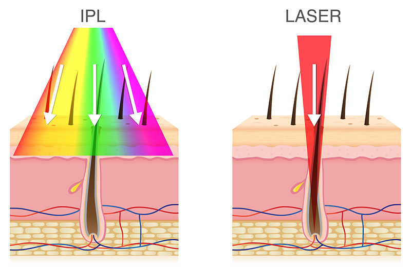 Épilation définitive : quelles différences entre laser et lumière